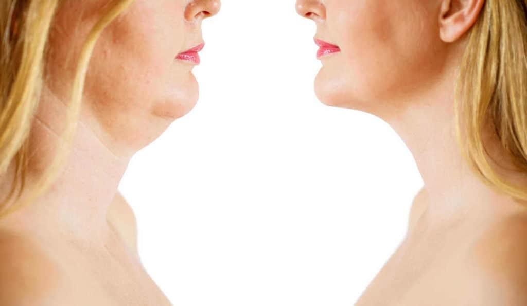 Double Chin treatment Twickenham before and after results
