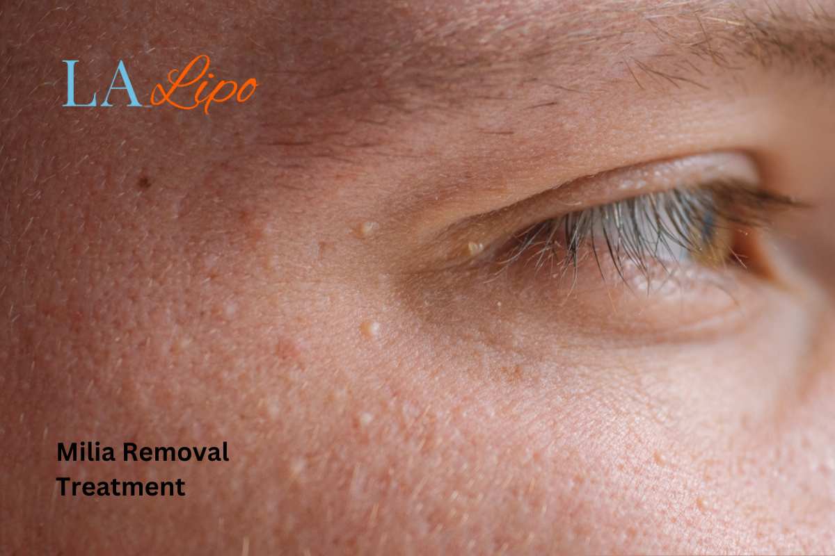 Cryopen Milia Removal: Is It the Easiest and Safest Option Twickenham?