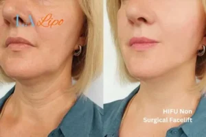 hi-fu for wrinkles Twickenham before and after results