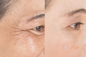 Before and after results of woman - HI-fu wrinkles reduction treatment Twickenham