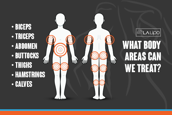 Graphic to show areas you can have LA-EMS Body Sculpting Twickenham treatment.
