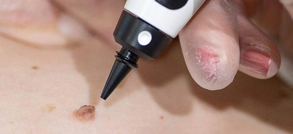 skin tag removal using cryopen Twickenham