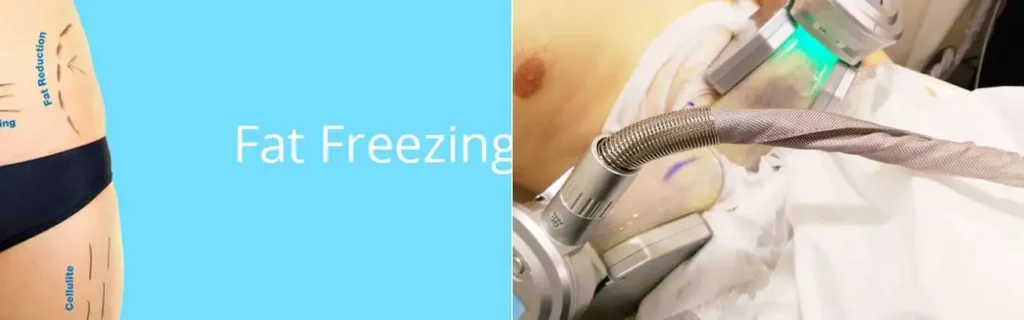 Fat freezing Twickenham on multiple areas of the body