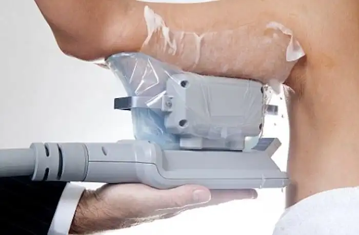 Picture of fat freezing Twickenham on the upper arms.