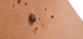 image of a skin tag Twickenham