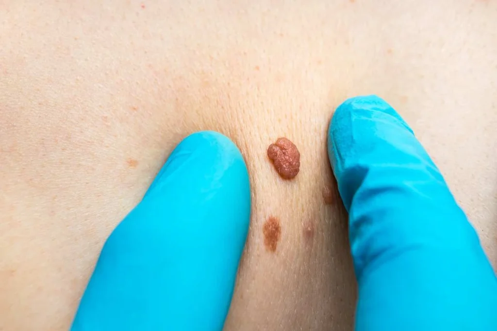 Consultant examining a skin tag Twickenham