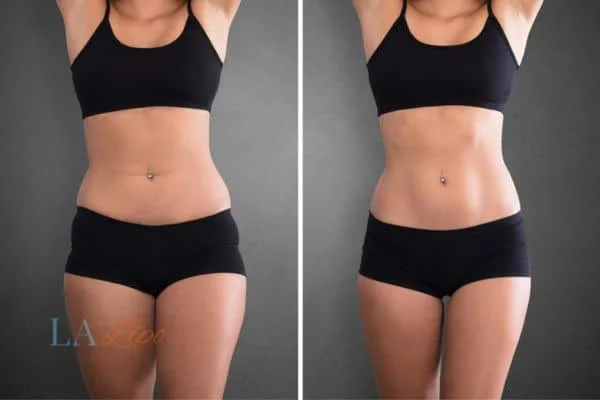 before and after results of non-surgical treatment to help a woman's body image and mental health Twickenham