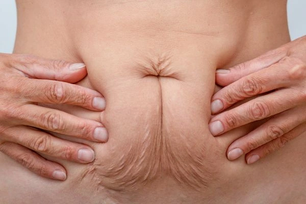 Image of a woman's stomach with loose skin - example of skin tightening Twickenham options