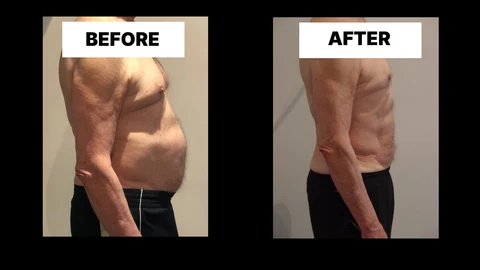 What Symptoms Can Diastasis Recti Cause in Men? Weak Core, Back Pain and Poor Posture Twickenham